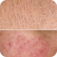 Dry, Irritated Skin